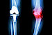 Gelenkersatz (Endoprothesen) von Knie/Schulter und Hüftgelenk